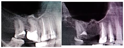 bichats fettpute|Anatomical and Surgical Implications of the Usage of Bichat Fat Pad in.